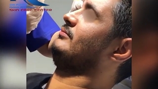 فیلم تزریق بوتاکس توسط دکتر مولازاده در مطب