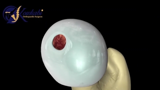 فیلم واقعی جراحی تعویض مفصل زانو