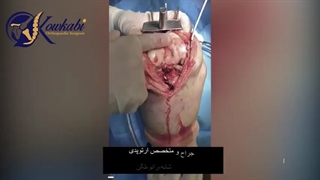 فیلم جراحی تعویض مفصل زانو بیمار 67 ساله