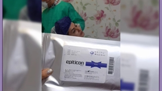 لیفت ابرو بدون جراحی پیلینگ