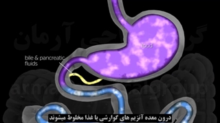 فرآیند عمل اسلیو معده
