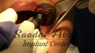 کاشت دو واحد دندان