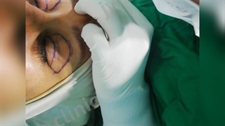 انجام عمل بلفاروپلاستی پلک بالا توسط دکترظاهریانی جراح ومتخصص چشم درکلینیک تخصصی جُوان