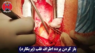 عمل میگزوما در بیمارستان فوق تخصصی کوثر با تجهیزات بروز و کادردرمانی مجرب