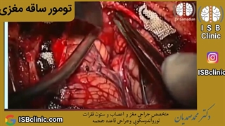 عمل جراحی تومور ساقه مغزی