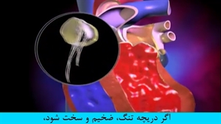 تعویض دریچه میترال (دولتی) قلب
