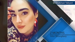 دو ماه بعد از رینوپلاستی | دکتر یحیوی
