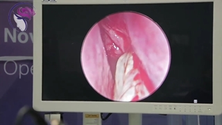 فیلم جراحی درمان سینوزیت مزمن در آقای ۳۶ ساله