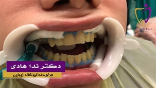 فیلم واقعی بلیچینگ یا سفید کردن دندان ماموپلاستی