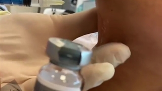 رفع غبغب با استفاده از روش های مکمل