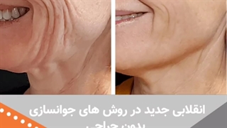 جوانسازی صورت با مزوژل پروفایلو