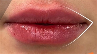 یک تزریق ژل لب بی نقص