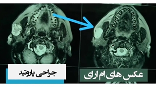 جراحی تومور پاروتید