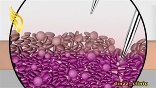 اگه نمی دونید میکرونیدلینگ چیه، تا آخر ببینید !