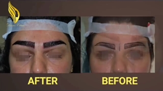 یک قدم تا زیبایی با کاشت ابرو !