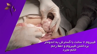 عمل فیبروم 7 سانتی در خانم مجرد