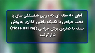 پلاتین گذاری به روش بسته در آقای 47 ساله