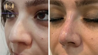 کوچک کردن بینی های گوشتی بدون جراحی، با فرمول انحصاری