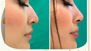 فیلم قبل و بعد اصلاح فرم بینی بدون جراحی