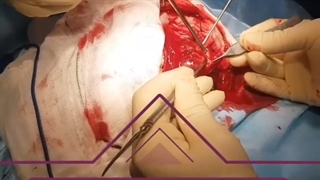 بهبودی خانم جوان سه روز پس از جراحی تومور مغزی