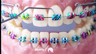 ارتودنسی دندان
