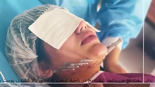لیفت غبغب با نخ