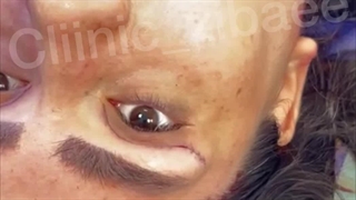 رفع افتادگی پلک در کلینیک آرتین