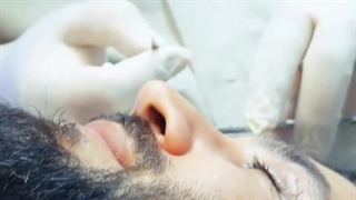 عمل زیبایی پلک بلفاروپلاستی بالا و پایین در آقایان