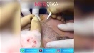 کاشت ریش بدون بخیه در مشهد