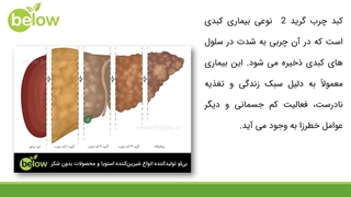 کبد چرب گرید 2 چیست؟