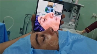 رینوپلاستی در کلینیک آرتین