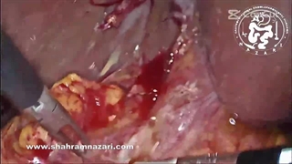 LCBD exploration & re anastomosis