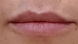 تزریق فیلر لب - دکتر حمید ارونقی پیلینگ شیمیایی