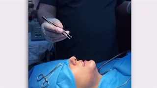 پروتز چانه با بی حسی موضعی | دکتر خوروش