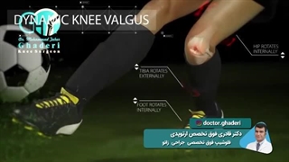 پارگی رباط صلیبی