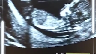 سونوگرافی NT و NB