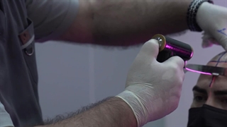 The History of Micrograft Hair Transplantation