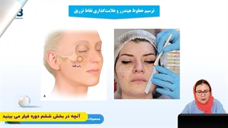 آموزش کانتورینگ صورت با فیلر | دکتر بیدکی