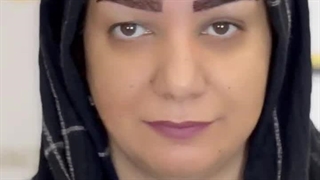 کاشت ابرو به روش sut بدون جراحی در کلینیک رنسانس
