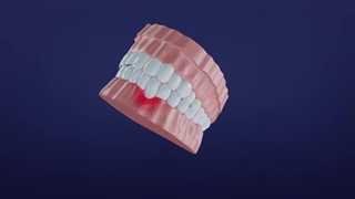 مراحل آماده‌سازی برای کاشت ایمپلنت دندان؛ قبل از جراحی چه باید بدانید؟