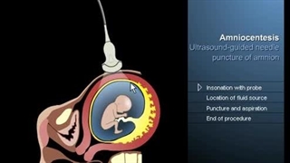آزمایش آمنیوسنتز چگونه انجام میشود؟